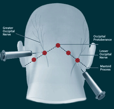 Side effect of steroid injection in knee