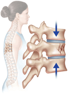 Compression Fractures and Lower Back Pain