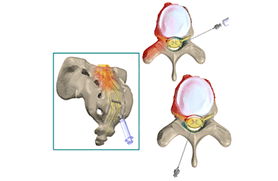 Epidural Steriod injections