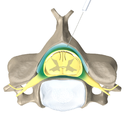 epidural injection for back pain