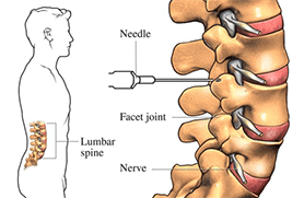 Intradiscal injection steroid