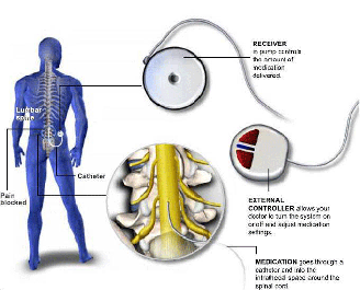 Lower back pain now treated by implantable nerve stimulation device -  UCHealth Today