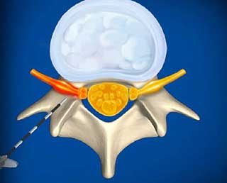 Transforaminal injection