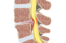 pinched nerve back pain