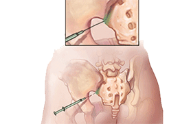 Hip joint steroid injection cpt code