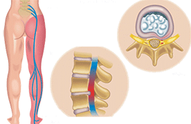 sciatic pain