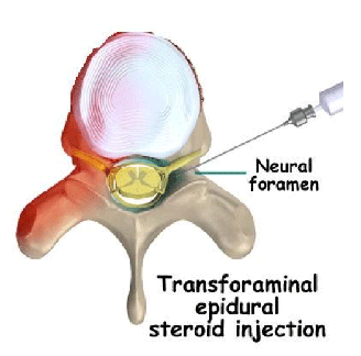 Lesi lumbar epidural steroid injection