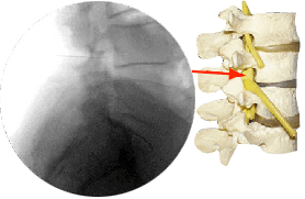 Lumbar Transforaminal Epidural Steroid Injection