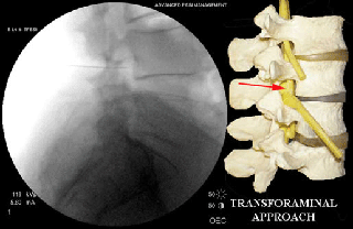 Epidural steroid injection lumbar disc