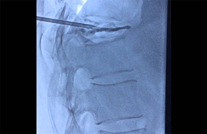 Vertebroplasty Xray