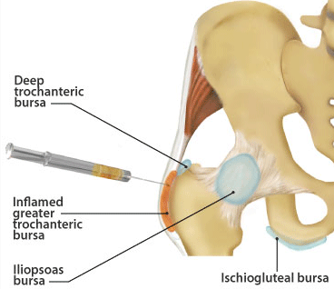 Corticosteroid injection for trochanteric bursitis