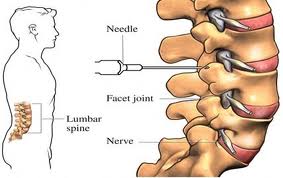 Lumbar epidural steroid injection