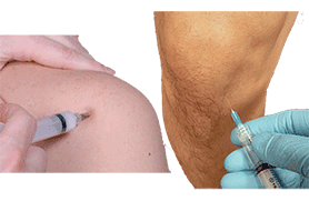 joint injections for arthritis