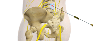 Lumbar Sympathetic block