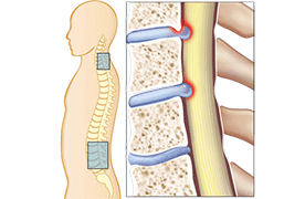 Spinal Stenosis