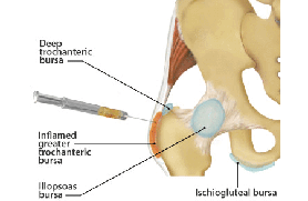 Epidural steroid injection hip pain