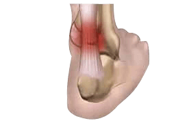 Tendinopathy incl Achilles tendonitis