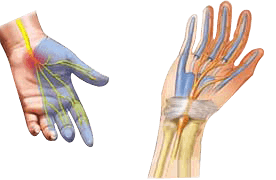 Carpal Tunnel Syndrome