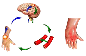 Complex Regional Pain Syndrome