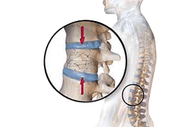 Chronic Post-surgical pain