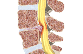 Pinched Nerve Pain / Radiculopathy