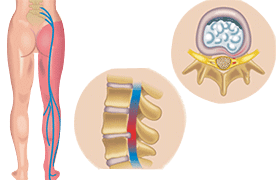 Sciatica