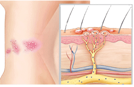 Shingles and Postherpetic neuralgia