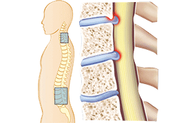 Spinal Stenosis