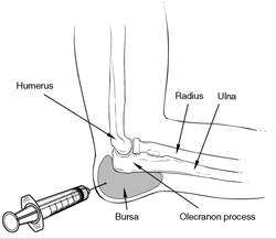 bursa injection
