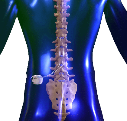 Spinal Cord Stimulator for pain relief