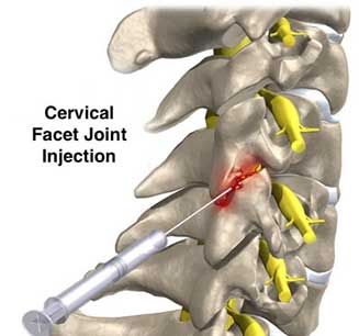 Cervical Facet joint injection