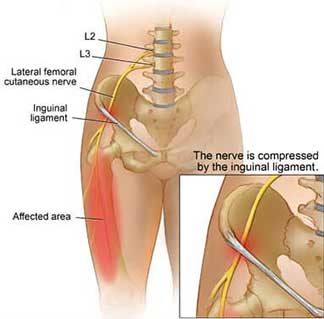 Meralgia paresthetica (Leg Pain) : Diagnosis, Treatment