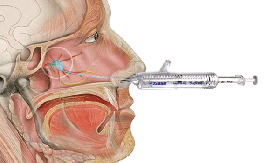 Trigeminal block