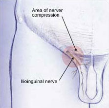 ilioinguinal neuralgia