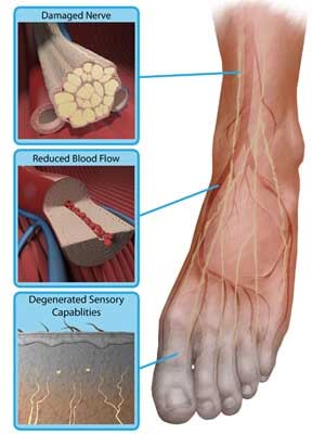 peripheral neuropathy foot pathophysiology