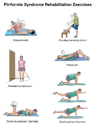 Piriformis Syndrome, Symptoms, Causes & Relief