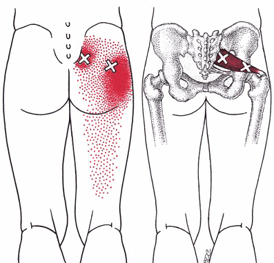 Trigger point injection