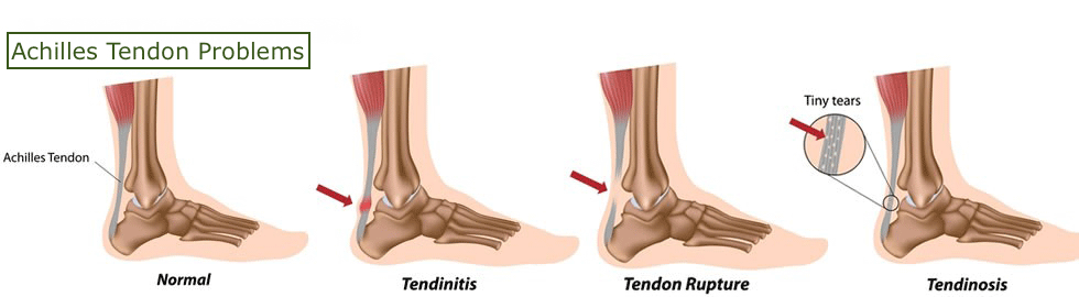 Can Plantar Fasciitis Cause Ankle Pain? – Easy Posture Brands