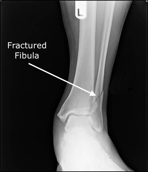 fractured fibula