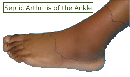 Septic Arthritis