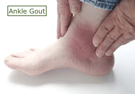 Ankle Gout