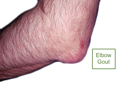 Elbow Gout