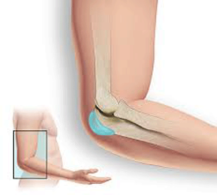 Corticosteroid injection for trochanteric bursitis