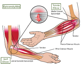 Steroidal injections