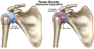 Frozen shoulder