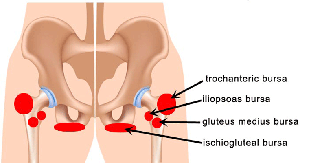 Ischial bursitis corticosteroid injection