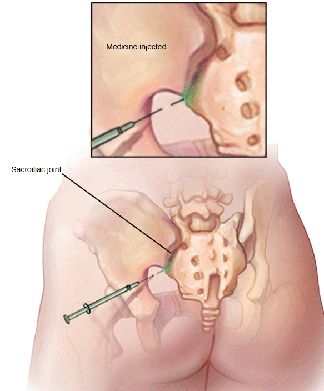 Steroid injections for migraines