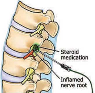 Lumbar translaminar epidural steroid injection