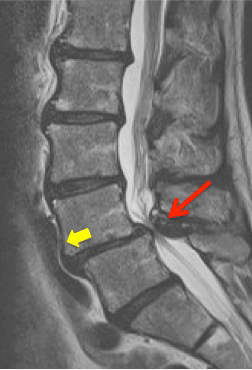 Spinal Stenosis MRI