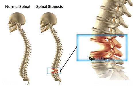 Spinal Stenosis